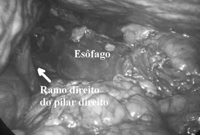 REVISTA BRASILEIRA DE VIDEOCIRURGIA - RELATO DE CASO